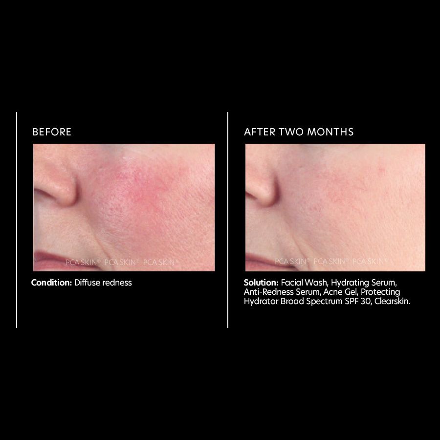Anti-Redness Serum 30ml
