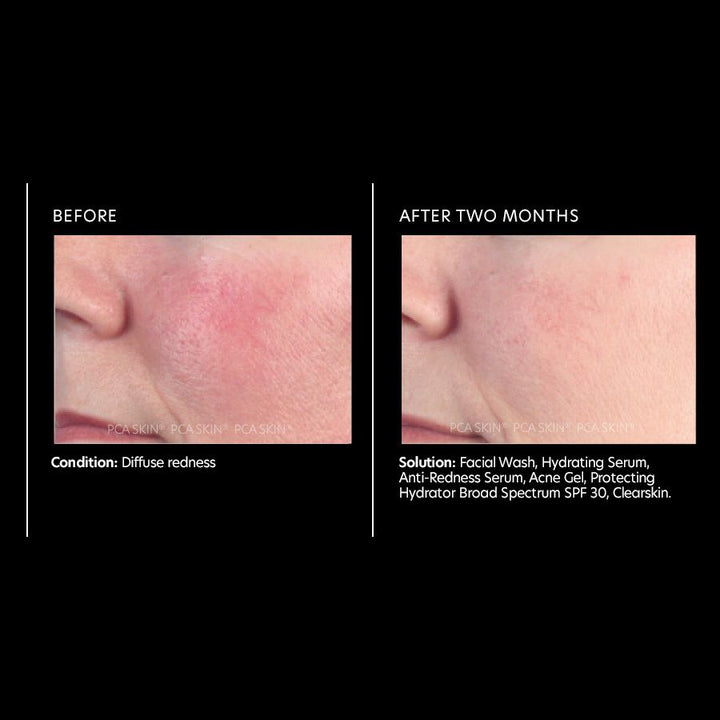 Anti-Redness Serum 30ml