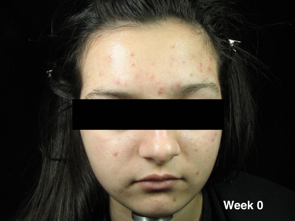 Système de traitement contre l'acné