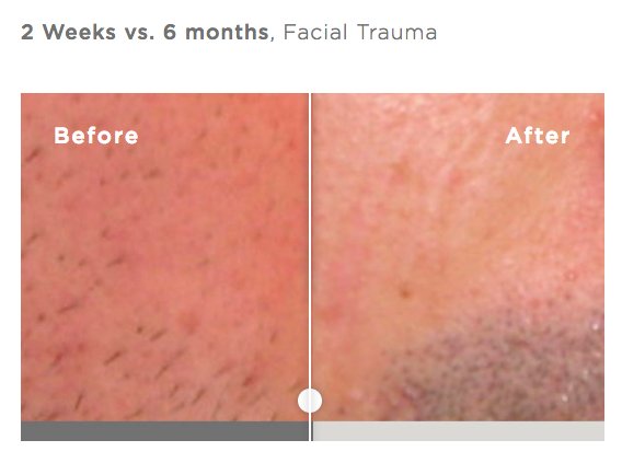 Scar Recovery Gel with Centelline 14.2g